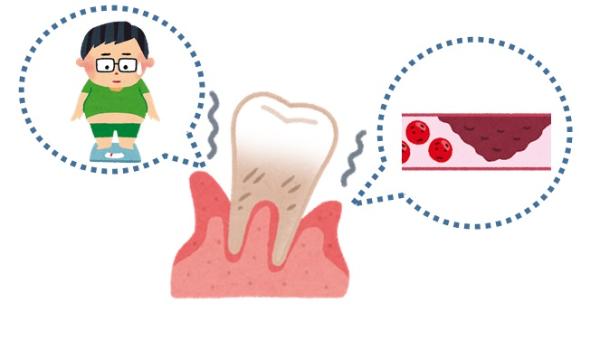 歯周病が引き金となるといわれているメタボリックや動脈硬化を表したイラスト